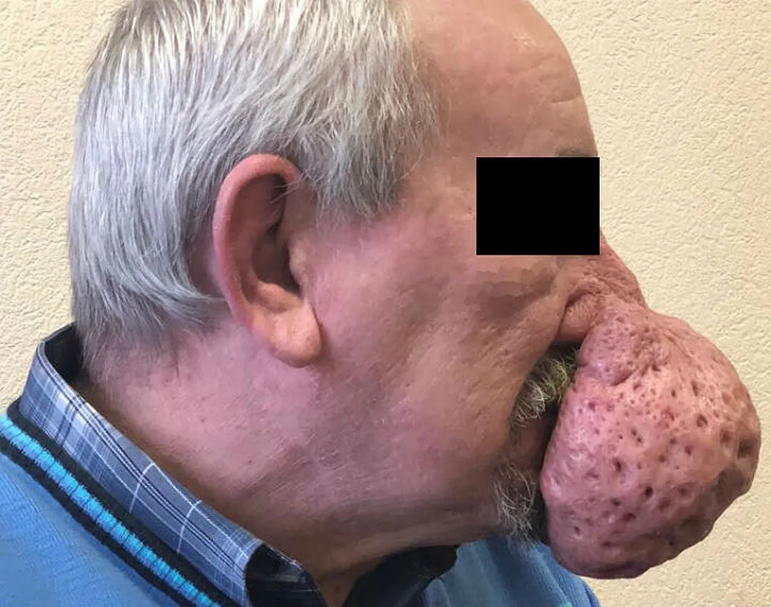 Мужчина лишился полкило носа благодаря врачам