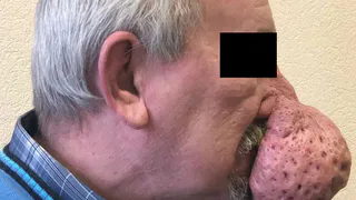 Мужчина лишился полкило носа благодаря врачам