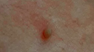 Папилломы у человека: знать и действовать