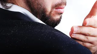 Медик назвала способы избавиться от перхоти