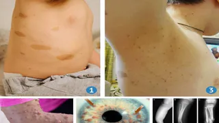 Во Владимирской ОДКБ врачи наблюдают ребёнка с редким генетическим заболеванием