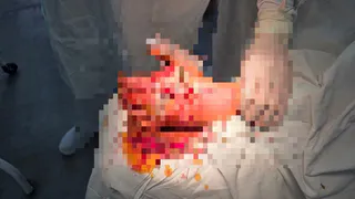 Во Владимире врачи спасли руку мальчику после взрыва петарды