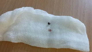 В чувашском Центре травматологии успешно извлекли осколок из тела бойца СВО