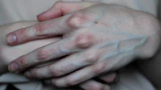 Аллергия в пожилом возрасте