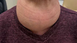 В РКБ Татарстана удалили гигантскую щитовидную железу — размером с голову