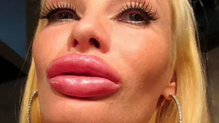 Страшный салон: в Брянске увеличивали губы запрещёнными препаратами