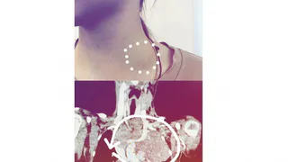 Владимирские медики обнаружили у 16-летнего подростка редкую опухоль