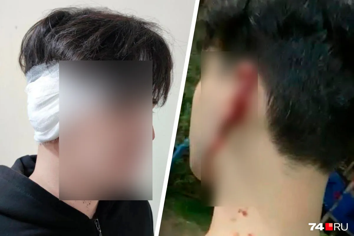 В Челябинской области в ходе драки мужчине откусили ухо: полиция разыскивает нападавшего
