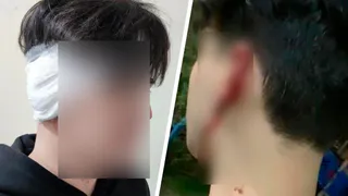 В Челябинской области в ходе драки мужчине откусили ухо: полиция разыскивает нападавшего