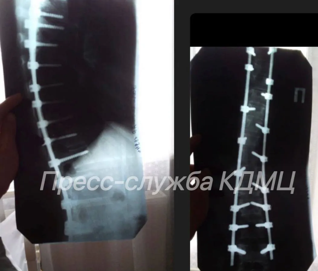 Чудо рождения: в КДМЦ Челнов помогли женщине с металлическими имплантами стать мамой