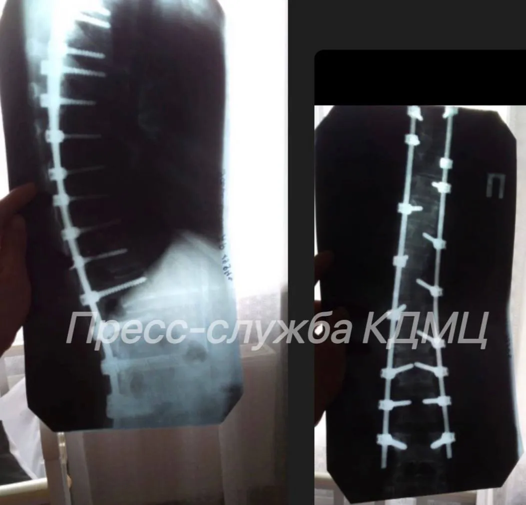 Чудо рождения: в КДМЦ Челнов помогли женщине с металлическими имплантами стать мамой