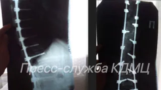 Чудо рождения: в КДМЦ Челнов помогли женщине с металлическими имплантами стать мамой