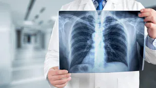 Мошенники стали «записывать» россиян на флюорографию