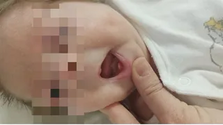 В областной детской больнице новорождённому удалили редкие неонатальные зубки