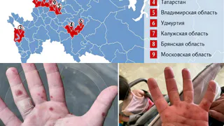 Как предотвратить заражение вирусом Коксаки