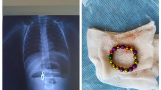 В Чувашии детские врачи спасли детей, проглотивших магнитные шарики и бусы