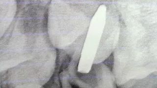 Стоматологи помогли мальчику, который случайно воткнул стержень ручки в зуб