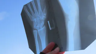 Около 800 человек обратились в травмпункт в новогодние праздники