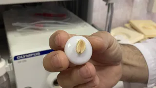 Он находился там целый месяц: врачи достали из бронхов девятимесячного рязанца орех