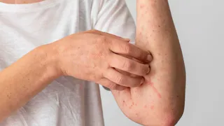 Во Владимире многих детей отправили на каникулы, чтобы не допустить вспышки кори