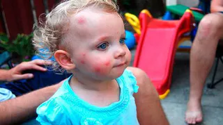 4-летнюю нижнекамку покусали клопы