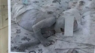 В нижнекамской реанимации уже почти год находится малыш со множественными патологиями развития
