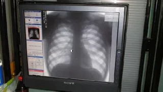 В Нижнекамске работал флюорографический кабинет на колесах