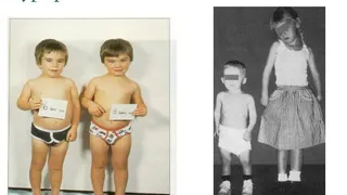 Во Владимире у новорожденного диагностировали редкое эндокринное заболевание