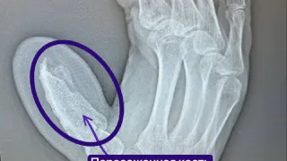 Казанские врачи вырастили пациенту новый палец на руке