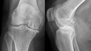 В России создан гель, который восстанавливает кости