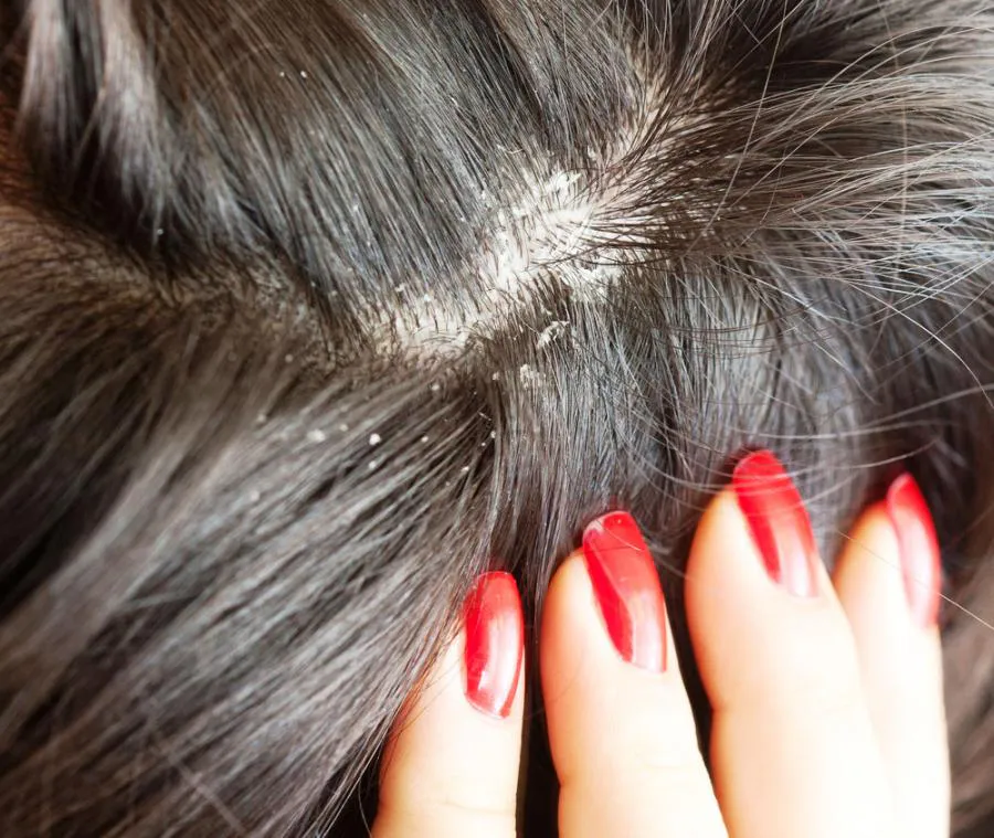 Врач назвала эффективные способы избавиться от перхоти