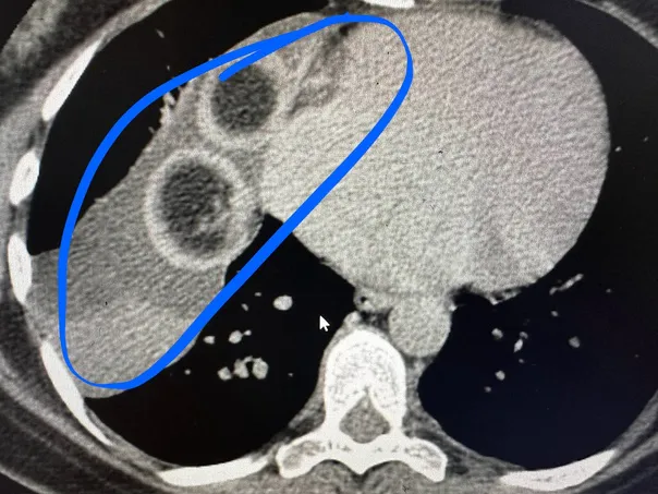 В Казани хирурги удалили 15-ти сантиметровую дермоидную кисту с клубками волос внутри