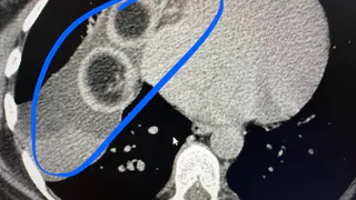 В Казани хирурги удалили 15-ти сантиметровую дермоидную кисту с клубками волос внутри 