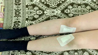 Владимирские врачи исправили тяжелую деформацию ног у 13-летнего мальчика