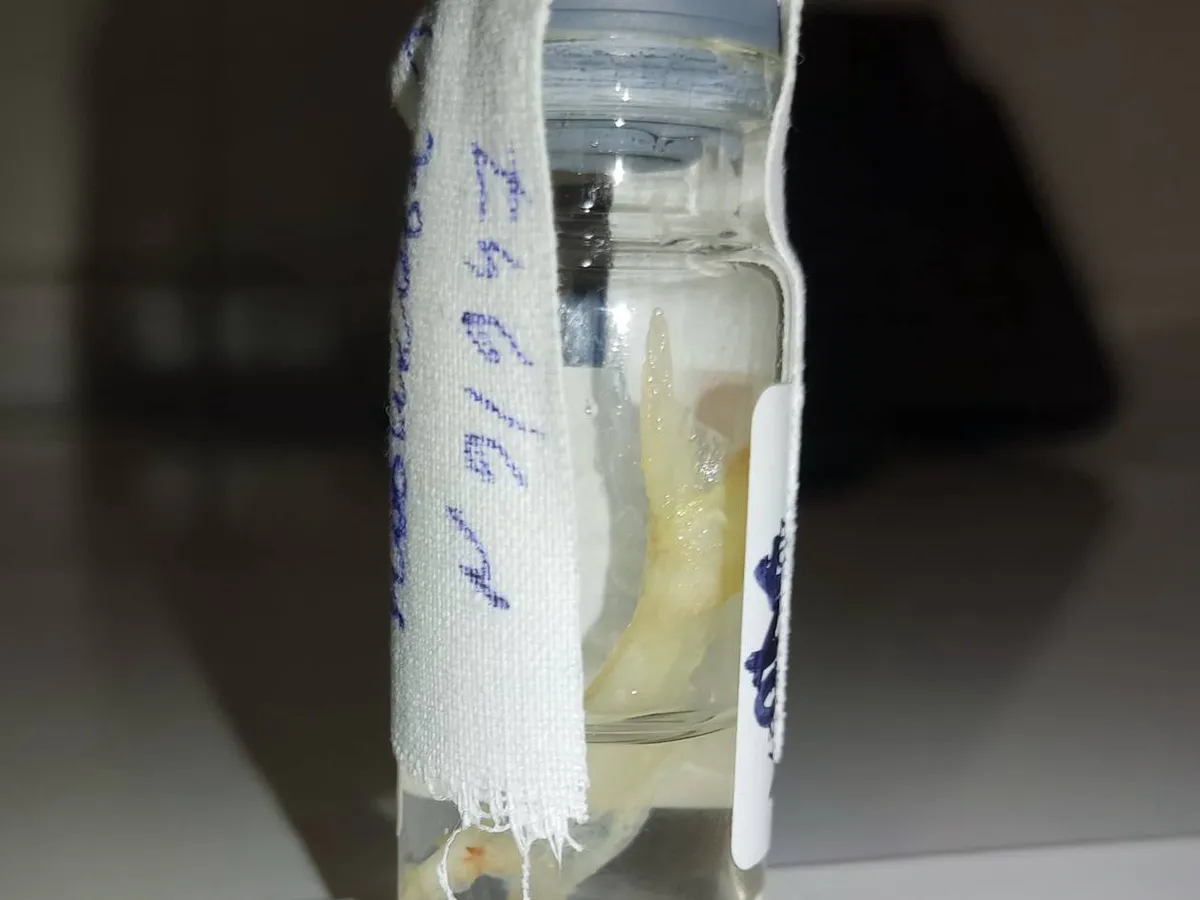 В РКБ Татарстана хирургам пришлось извлекать рыбные кости из горла двух пациенток