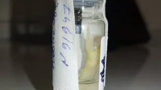 В РКБ Татарстана хирургам пришлось извлекать рыбные кости из горла двух пациенток