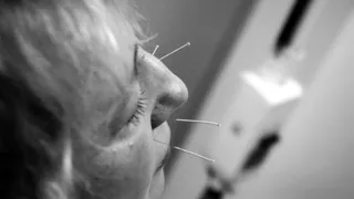Иглоукалывание избавит от табачной зависимости
