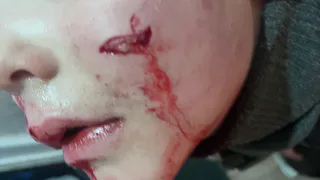 В Коми бездомная собака укусила в лицо шестилетнего ребенка