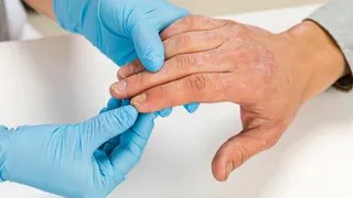 Нехитрые правила помогут избежать обострений экземы