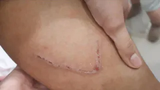 Нападение собаки на ребенка. Об инциденте рассказала мама девочки