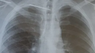 Откололась от ключицы: хирурги ОКБ достали из спинного мозга рязанца спицу