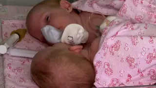 Операция по разделению сиамских близнецов из Старожилова длилась 5 часов