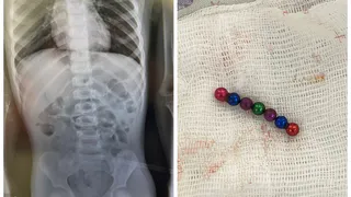 Во Владимире врачи спасли четырехлетнего мальчика, проглотившего 9 магнитных шариков