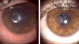 16-летней девушке из Чувашии потребовалась операция из-за неправильного ношения контактных линз