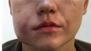 Небезопасная косметология: росздравнадзор показал последствия некачественных услуг