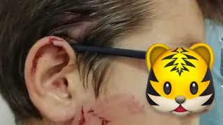 Под Рязанью питбуль покалечил ребенка: родственники мальчика хотят огласки