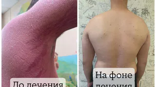 Врачи ОДКБ помогли ребенку с тяжелой формой псориаза