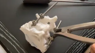 В ОКБ Рязани операции на позвоночник проводятся с использованием 3D-принтера