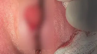 Врачи Владимирской ОДКБ провели сложную операцию ребенку с воспалением глаза