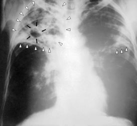 Рентгенограмма органов грудной клетки больного туберкулёзом лёгких